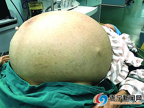 七旬老婦肚子大得很嚇人 取出70斤巨型腫瘤